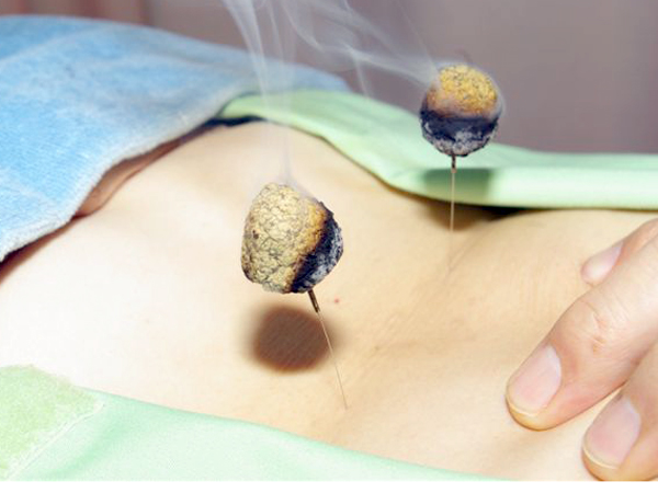 灸頭鍼治療は腰痛と肩凝りにすごく効きました。