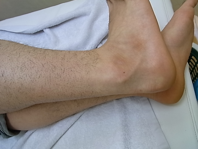 外傷性腓骨筋腱脱臼